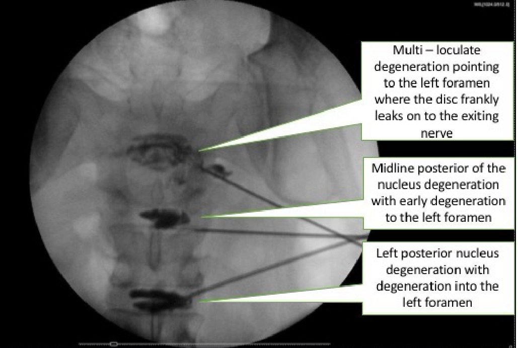 Spinal Pain