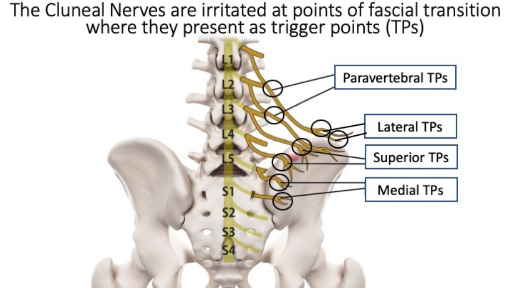 Cluneal Pain