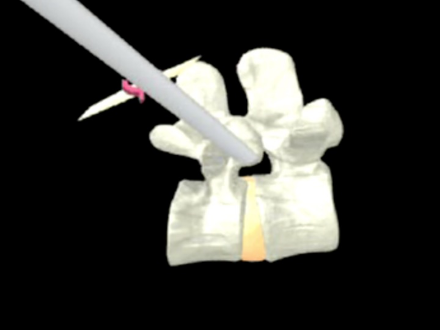 Spinal Pain