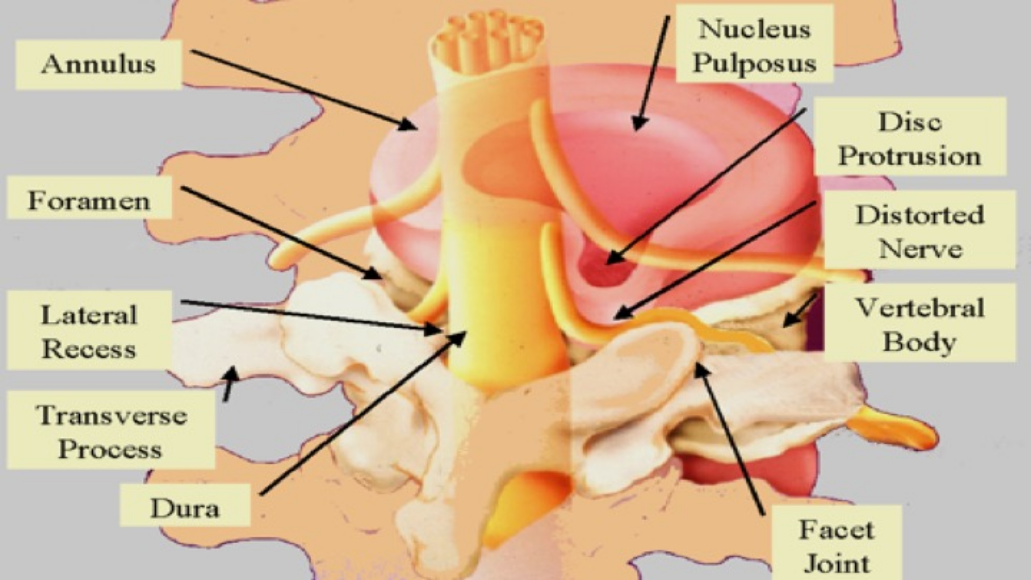Spinal Pain
